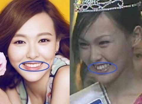 牙齿不齐明星,牙齿不齐明星的蜕变之路